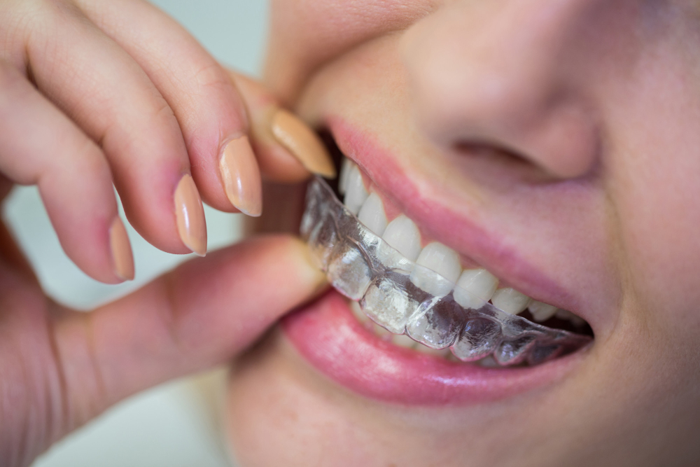 Straightening Your Smile with Invisalign- 6 Care Tips for Your Invisalign